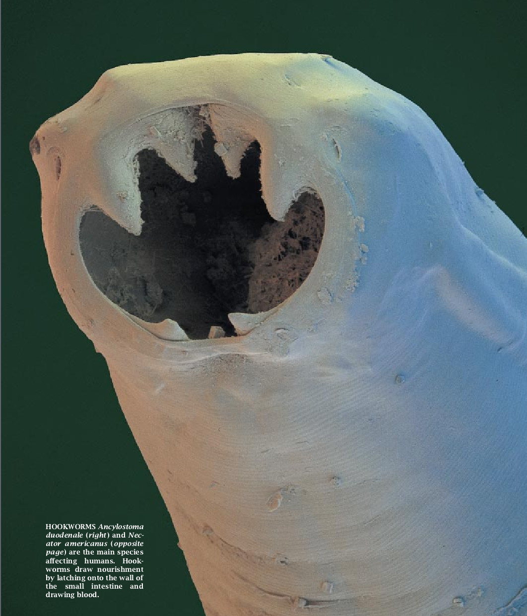 Hookworm Infection-02.jpg