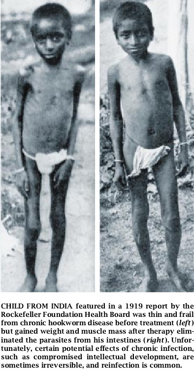 Hookworm Infection-05.jpg