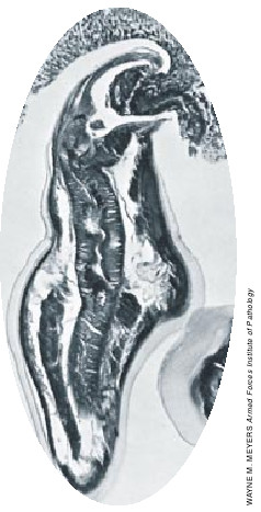Hookworm Infection-08.jpg
