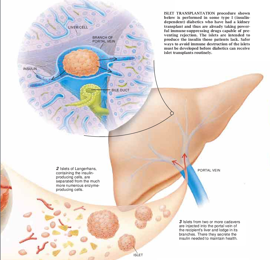 Treating Diabetes with Transplanted Cells-02.jpg