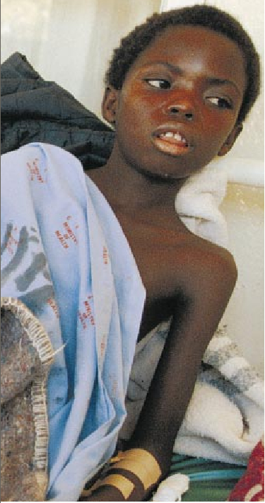Cerebrospinal Meningitis Epidemics-02.jpg