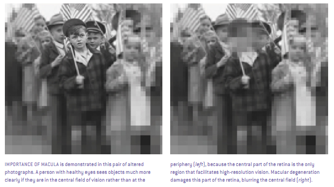 黄斑变性的挑战 4.png