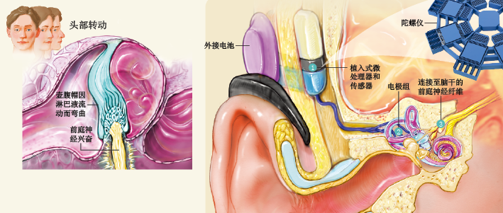 仿生耳恢复你的第六感 (3).png