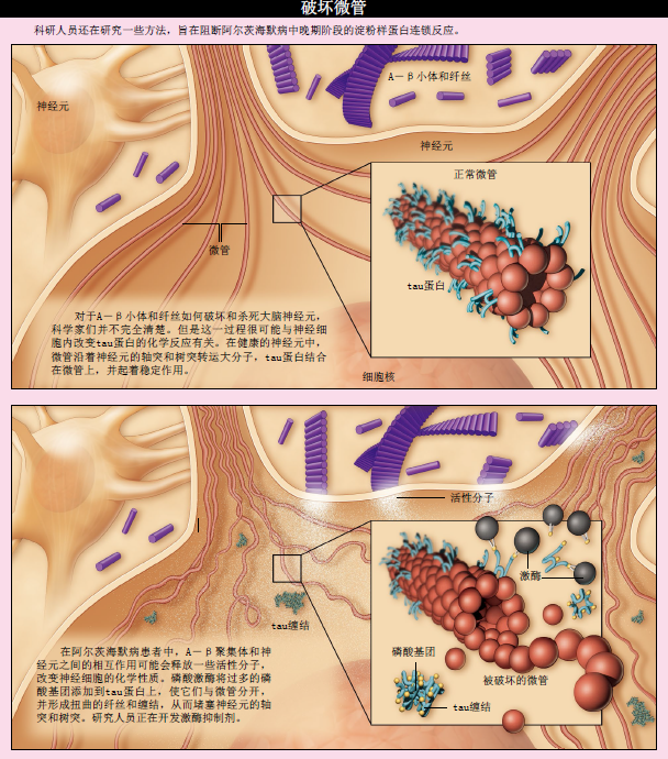 阿尔茨海默病 (4).png