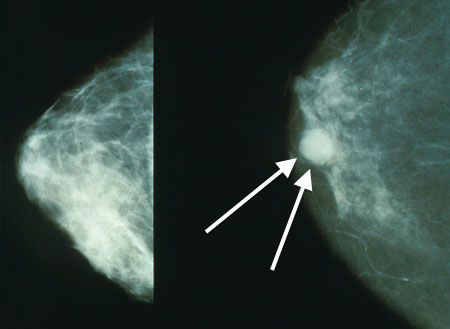 Mammo_breast_cancer_wArrows.jpg